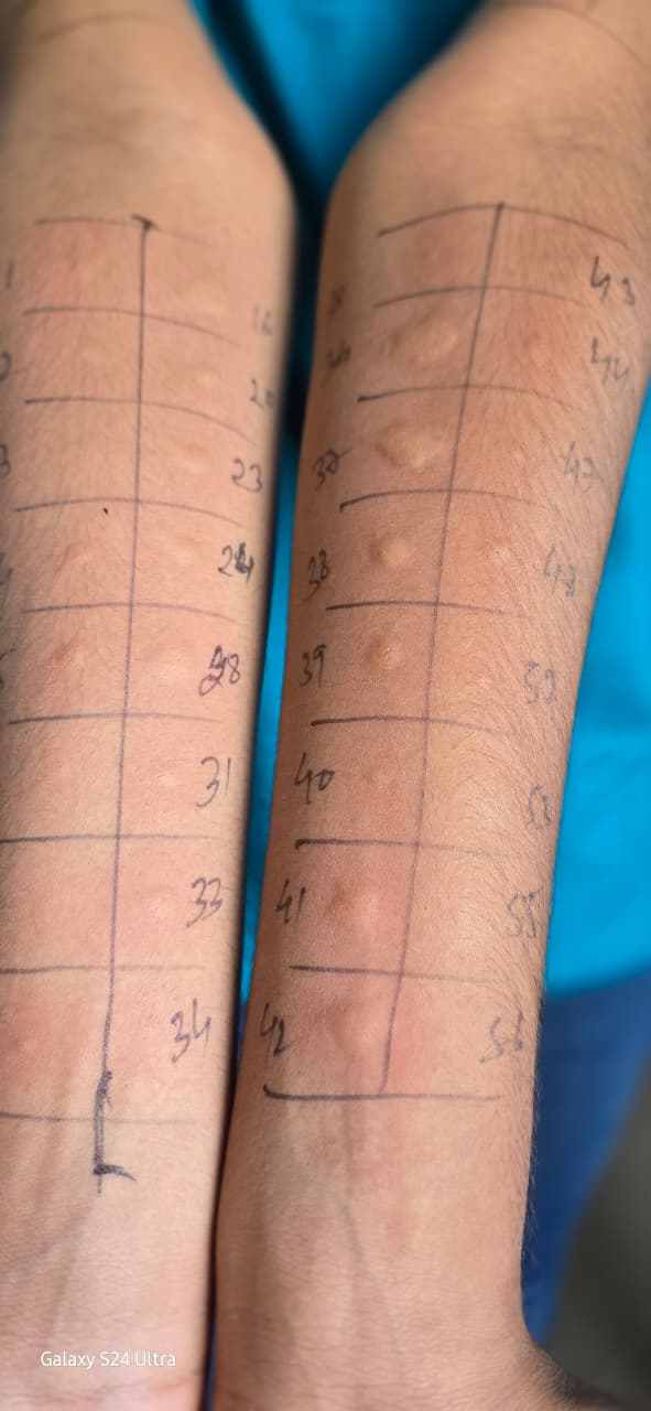 Allergy skin prick test